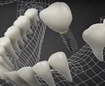 SQ implant